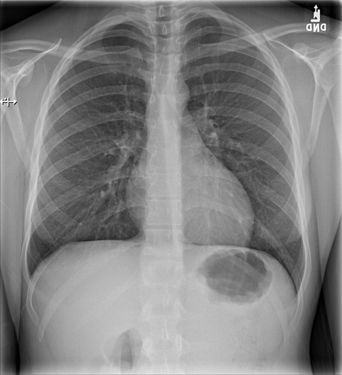 In The Following Example Vascular Redistribution Is Present 